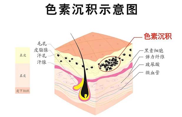 <b>睿辰科普  看完你就知道痘印，有救了！</b>
