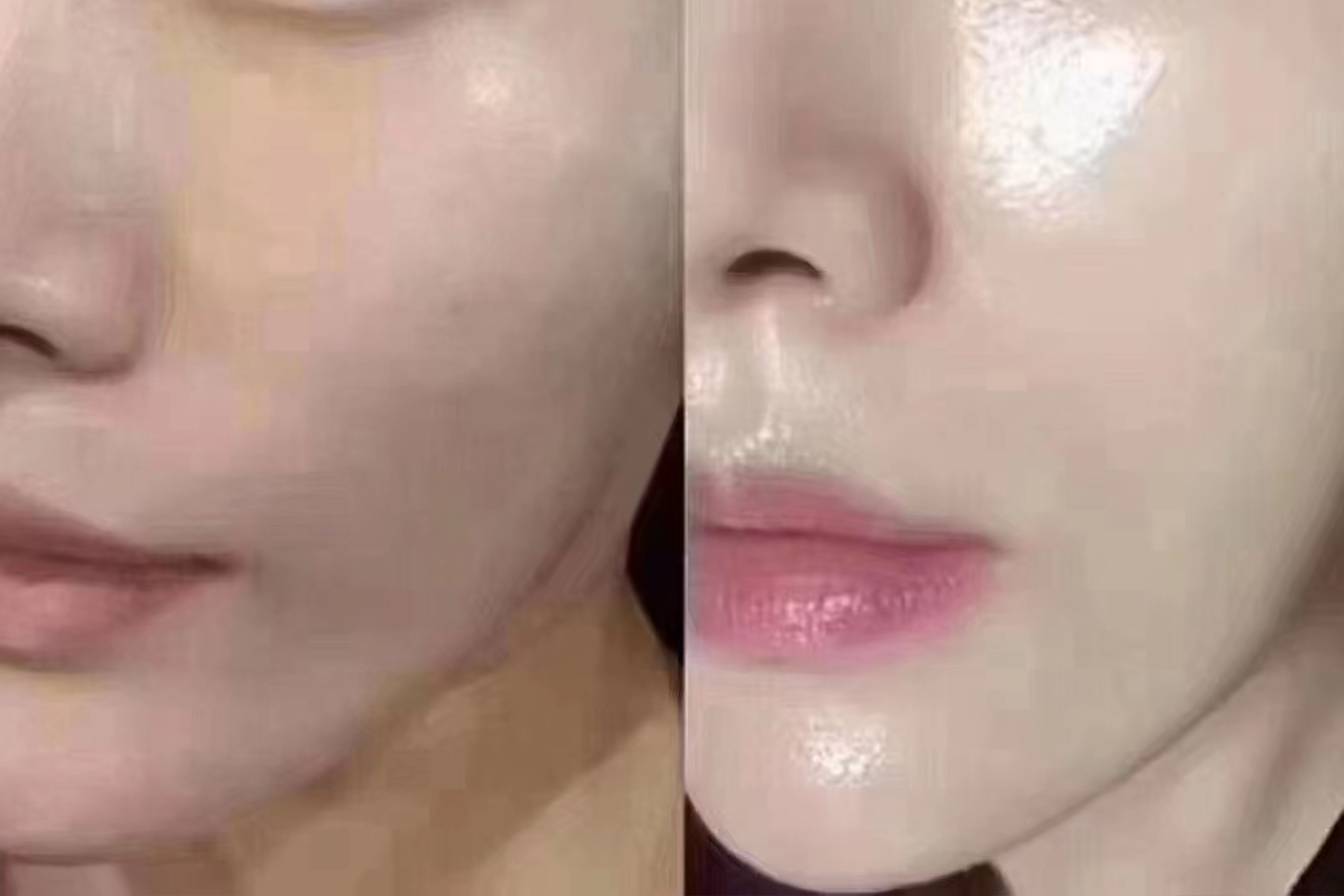<b>荣成睿辰//你听说过号称「 1 针 = 100 张面膜」的</b>