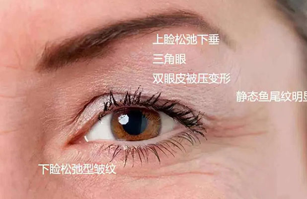 <b>睿辰医美//提眉术的适宜人群</b>