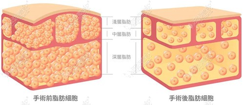 吸脂会让脂肪细胞会有变化